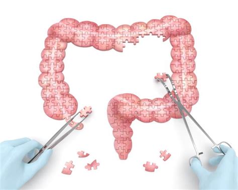 Diverticulose Et Diverticulite Causes Sympt Mes Et Traitement Cap