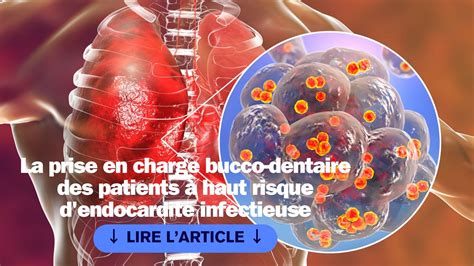 Mise à Jour Des Recommandations Pour La Prise En Charge Bucco Dentaire Des Patients à Haut