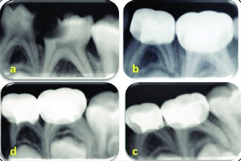 Periapical Radiographs Showing A Successful Formocresol Pulpotomy In