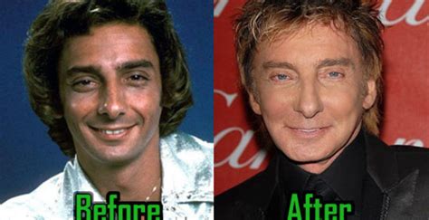 Barry Manilow: Plastic Surgery Transforms His Face - CelebritySurgeryIcon