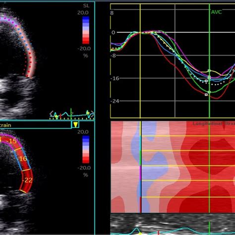 Acquisition Of Left Ventricular Apical Four Chamber Strain Imaging By