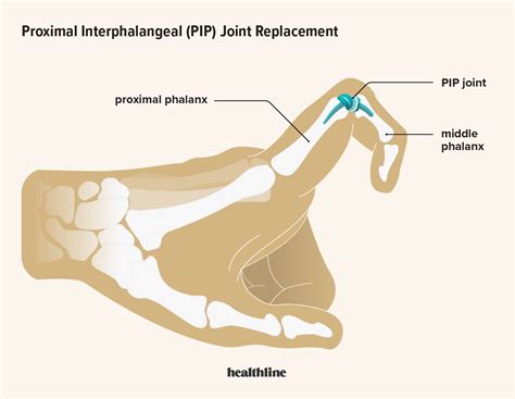 Proximal Interphalangeal (PIP) Joint Arthroplasty