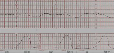 Fetal Heart Rate Assessment Flashcards Quizlet