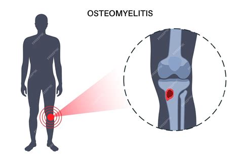 Enfermedad De Osteomielitis Dolor De Huesos Muertos De Rodilla