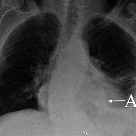 Pdf Caseous Mitral Annular Calcification Mimicking A Lung Tumor On Chest X Ray