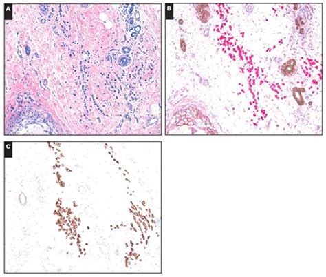 Classical Type Invasive Lobular Carcinoma With Her2 Overexpression