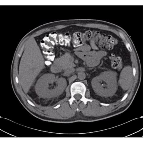 Ct Of Abdomen And Pelvis Without Iv Contrast Ct Of Abdomen And Pelvis Download Scientific