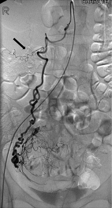 Ovarian Artery