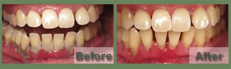 Austin Dentist For Gum Disease Options For Periodontal Disease Treatments