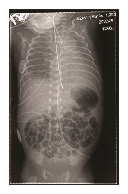 Initial Postinsertion Cxr Showing Appropriate Uvc Placement Just