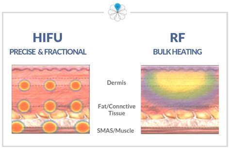 How Are Hifu And Radiofrequency Different What To Choose