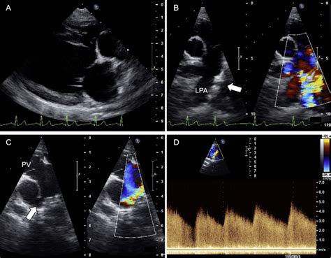 Transthoracic Two Dimensional Echocardiographic Images A Right