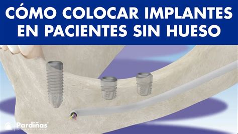 Cómo reponer DIENTES con IMPLANTES DENTALES si no TIENES HUESO YouTube