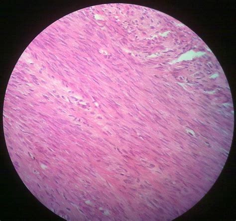 Leiomyoma – howMed