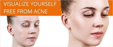 Acne Treatment Los Angeles - Acne Beverly Hills - Santa Monica