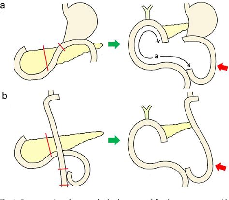 Total Gastrectomy With Roux En Y Esophagojejunostomy