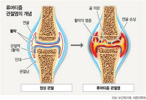 손가락 가운데 마디 아프고 입맛 떨어졌다면류머티즘 관절염 의심해보세요