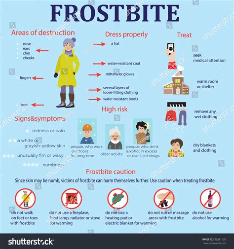 Frostbite Symptoms Protection Treatment Infographics Vector De Stock