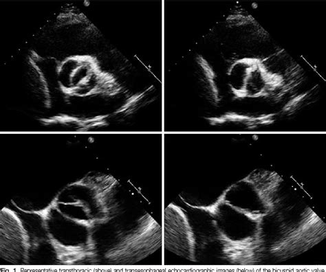 [PDF] Bicuspid Aortic Valve: Unresolved Issues and Role of Imaging Specialists | Semantic Scholar