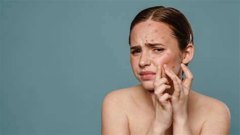 एक्ने दूर करने के उपाय Acne Dur Krne Ke Upay Healthshots Hindi