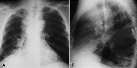 Chest Plain Radiography A Pa Frontal View B Lateral View Showing Download Scientific