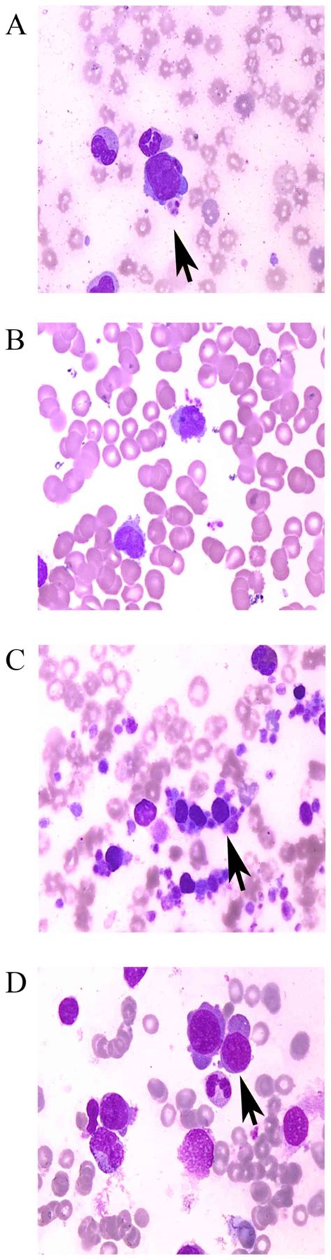 Clinical Diagnosis Of Adult Patients With Acute Megakaryocytic Leukemia