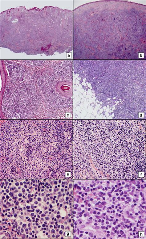 Primary Cutaneous CD4 Positive Small Medium Sized Pleomorphic T Cell