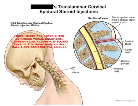 AMICUS Illustration of amicus,medical,translaminar,cervical,epidural ...