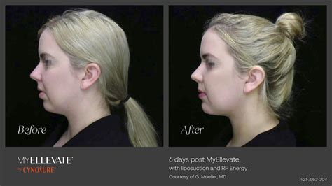 Neck Lift Reflect Clinic Patysmaplasty Surgery