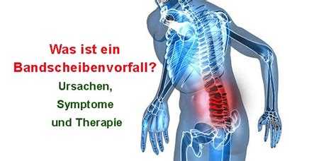 Was Ist Ein Bandscheibenvorfall Ursachen Symptome Und Therapie