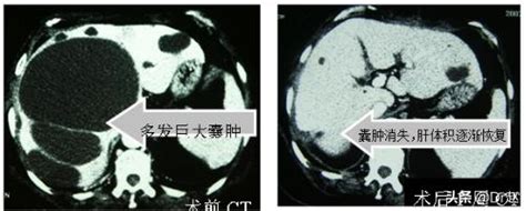 肝囊腫是什麼？哪些情況需要治療？聽聽醫生怎麼說吧 每日頭條