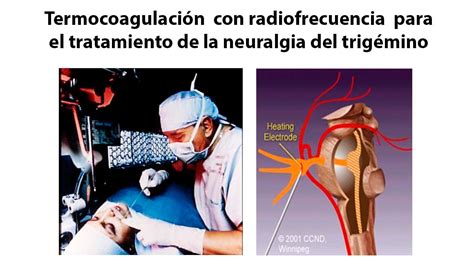 Termocoagulación Percutánea Del Ganglio De Gasser Con Radiofrecuencia Para