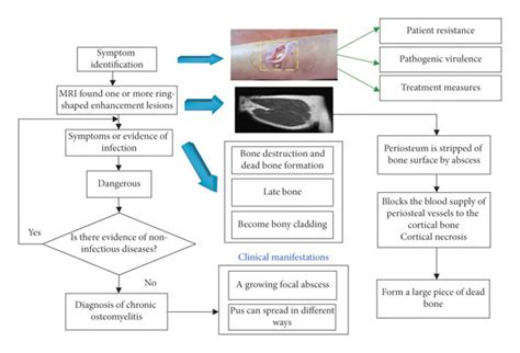 Schematic Diagram Of The Diagnosis Of Chronic Osteomyelitis Download