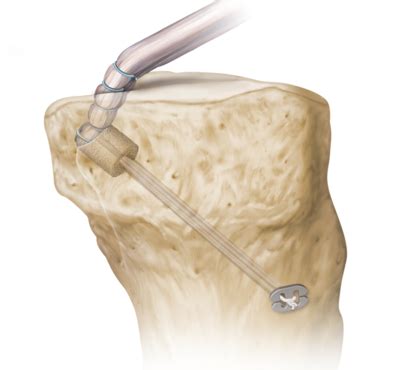 PCL Reconstruction