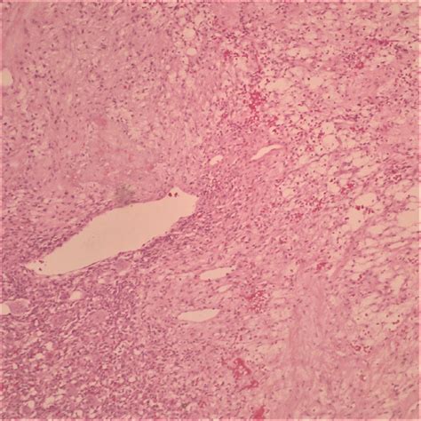 Histologic Image Of Phosphaturic Mesenchymal Tumor Illustrating