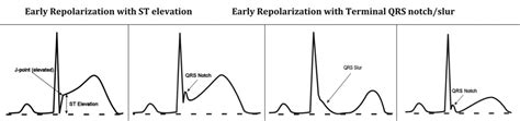 Electrocardiographic Early Repolarization Circulation