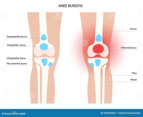 Knee Bursitis Prepatellar Bursitis Vector Illustration Cartoondealer