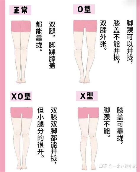 纠正X型O型XO型腿快速长高5cm 知乎