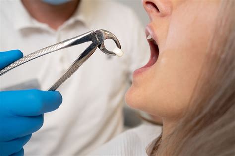 How Much Does A Tooth Extraction Cost Privately Didsbury Dental Practice