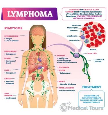 Lymphoma Cancer Treatment | Best Lymphoma Cancer Hospitals in India