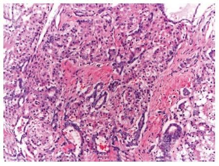 Cholangiocarcinoma Histology