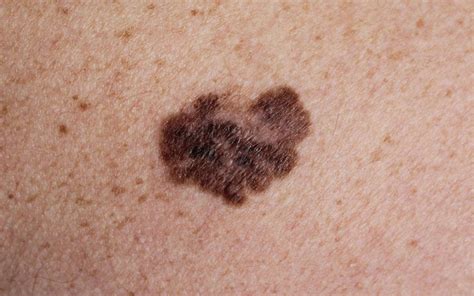 Melanoma Della Pelle Immagini Foto Sintomi E Metastasi