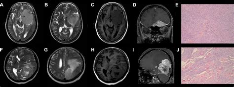 Frontiers Predicting The Grade Of Meningiomas By Clinical