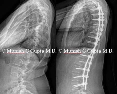 Idiopathic Scoliosis Teen Female Munish C Gupta Md