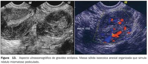 Radiologia Brasileira Anormalidades Do Primeiro Trimestre Da Gravidez