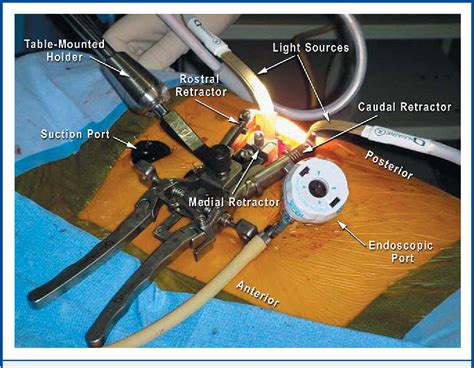 PDF Video Assisted Thoracoscopic Surgery Combined With A Tubular