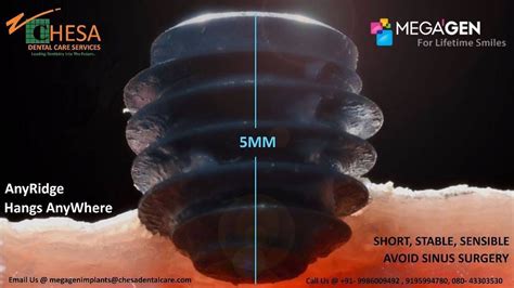 Megagen Implant Introducing The Special Short Mm Anyridge