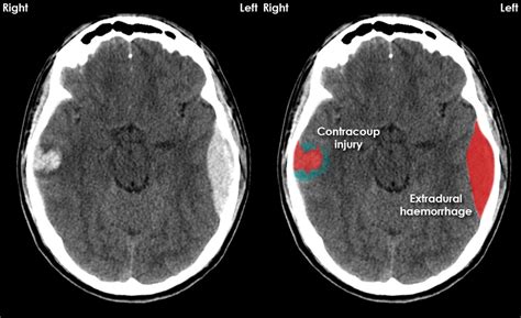 CT brain image gallery - EDH