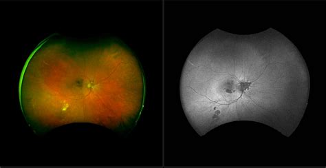 Age Related Macular Degeneration AMD