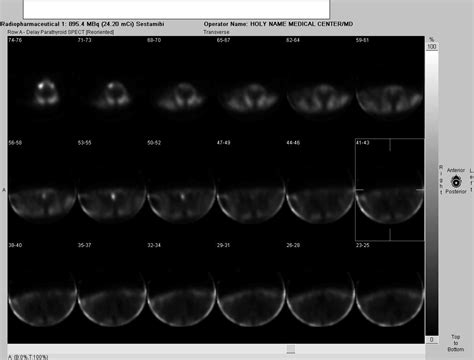 Nuclear Medicine Technology Program: Abnormal Parathyroid Scan